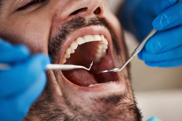 Best Emergency Dental Care for Broken or Chipped Teeth in Clarence, IA